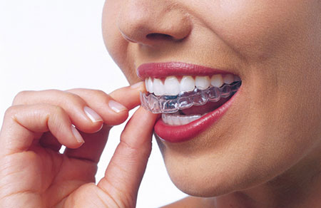 Invisalign® Invisalign®