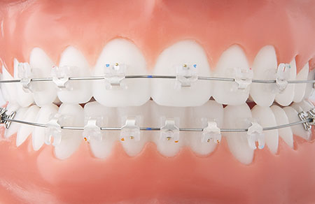 Keramik-Brackets Keramik-Brackets