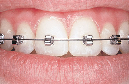 SPEED-Brackets SPEED-Brackets