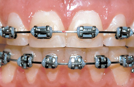 Brackets - festsitzende Behandlungsgeräte Brackets - festsitzende Behandlungsgeräte