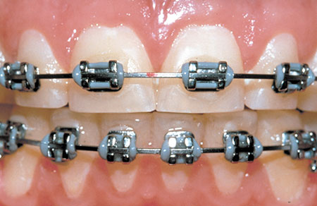 Brackets - festsitzende Behandlungsgeräte